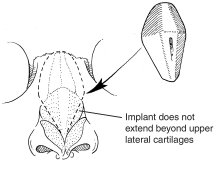 Illustration of correct placement of the Medpor Nasal Shell in the nose Illustration of correct placement of the Medpor Nasal Shell in the nose