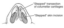 Illustration of the Semi-open Rhinoplasty incisions Illustration of the Semi-open Rhinoplasty incisions